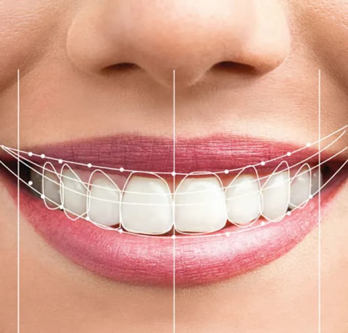 Smile Correction & Makeover