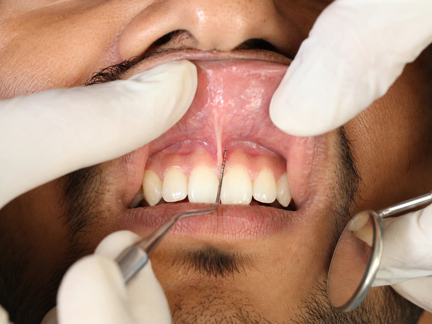 Minor Oral Surgery