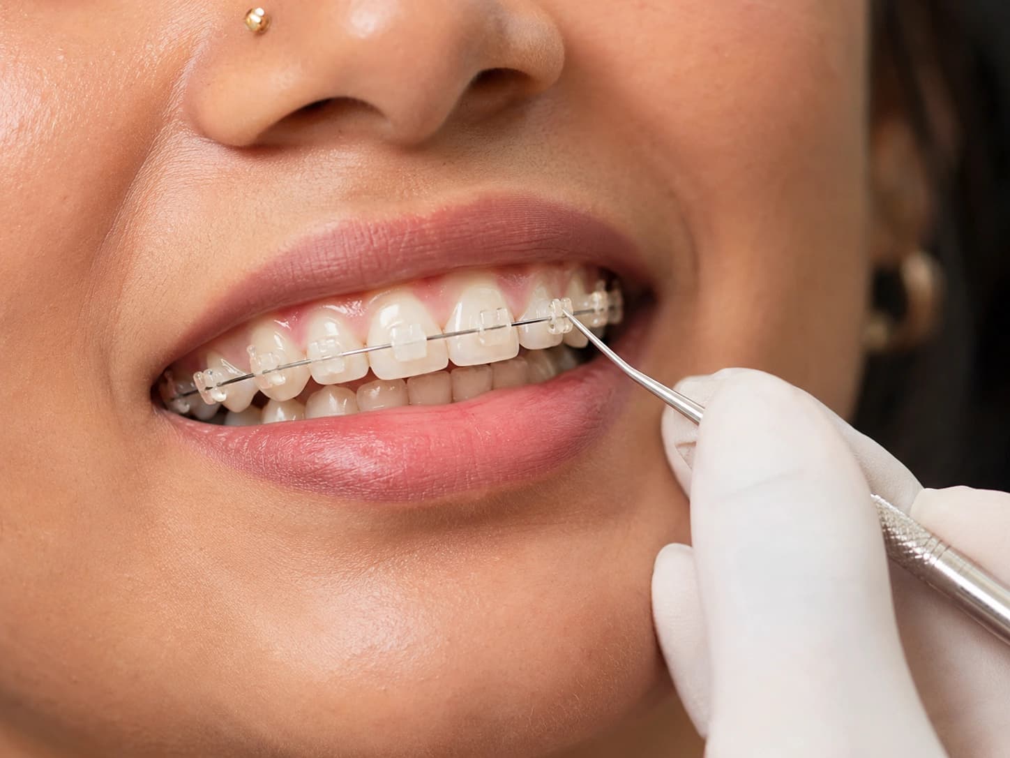 Traditional & Ceramic Braces